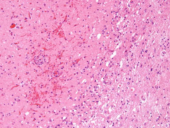 1D4 Hypotensive Brainstem Necrosis (Case 1) H&E N10 22