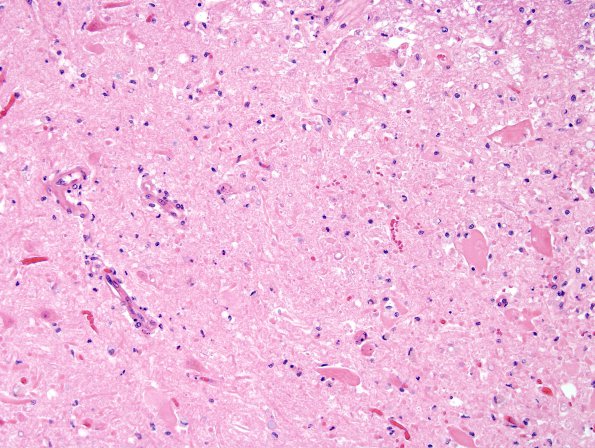 1D5 Hypotensive Brainstem Necrosis (Case 1) H&E N10 SCord 18