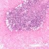 1E2 Hypotensive Brainstem Necrosis (Case 1) N9 H&E 10X