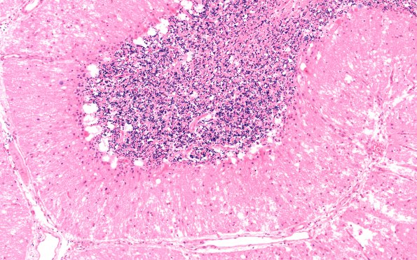 1E2 Hypotensive Brainstem Necrosis (Case 1) N9 H&E 10X