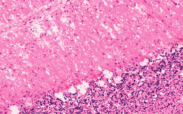 1E3 Hypotensive Brainstem Necrosis (Case 1) N9 H&E 20X