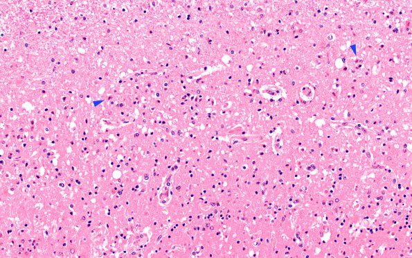 1F2 Hypotensive Brainstem Necrosis (Case 1) N5 H&E 10X copy