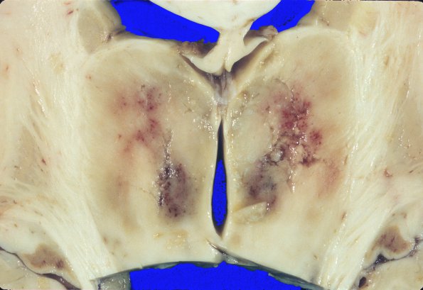 2A2 Hypoxia-Ischemia, SP cardiac arrest, 24hrs prior (Case 2) 8