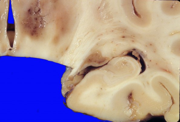 2A3 Hypoxia-Ischemia, SP cardiac arrest, 24hrs prior (Case 2) 3