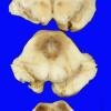 2A6 Hypoxia-Ischemia, SP cardiac arrest, 24hrs prior (Case 2) 4