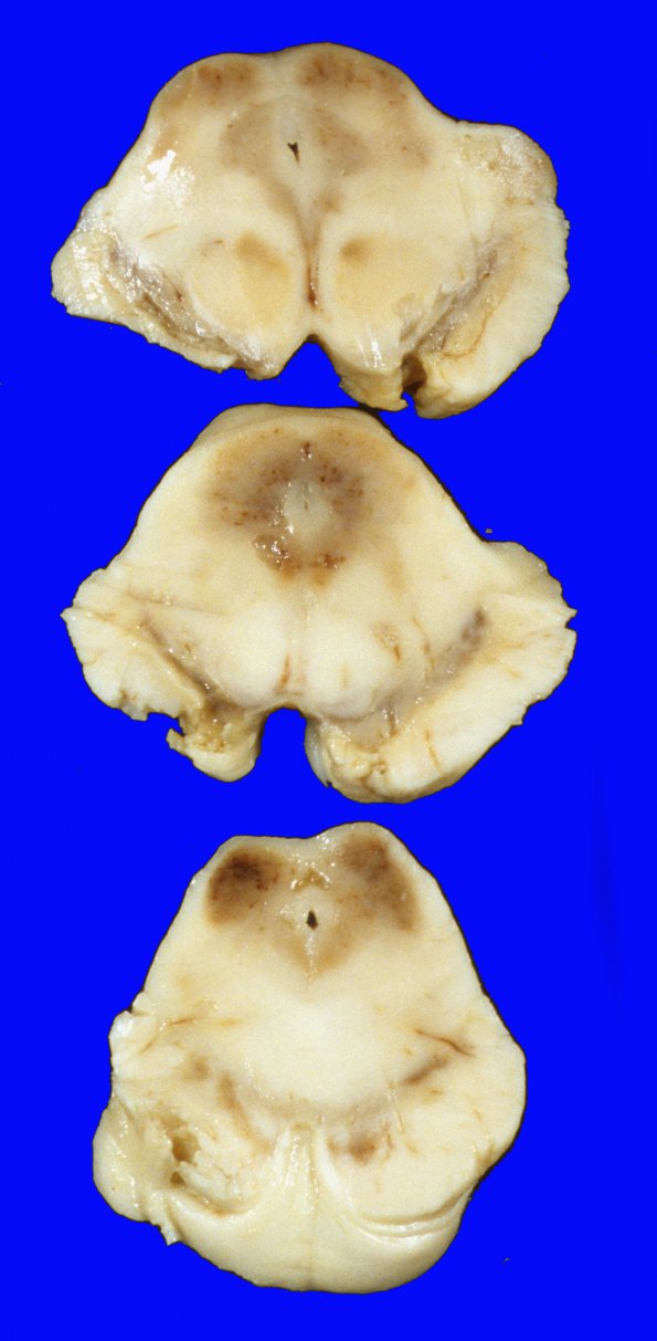 2A6 Hypoxia-Ischemia, SP cardiac arrest, 24hrs prior (Case 2) 4