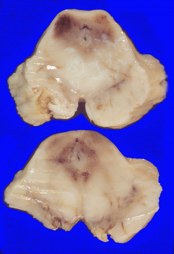 2A7 Hypoxia-Ischemia, SP cardiac arrest, 24hrs prior (Case 2) 5