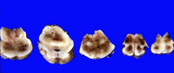 3A2 Hypotensive Brain Stem Necrosis SP cardiac arrest (Case 3) 79