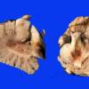 3A3 Hypotensive Brain Stem Necrosis SP cardiac arrest (Case 3) A