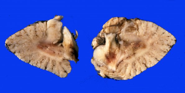 3A3 Hypotensive Brain Stem Necrosis SP cardiac arrest (Case 3) A