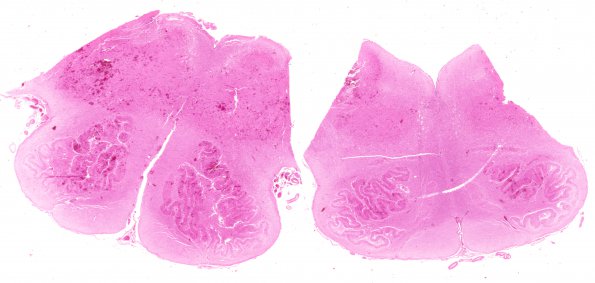 3B1 Hypotensive Brainstem Necrosis (Case 3) H&E N8 WM