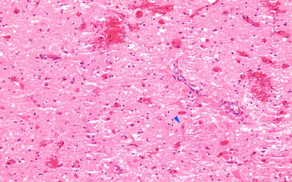 3B2 Hypotensive Brainstem Necrosis (Case 3) H&E N8 20X copy