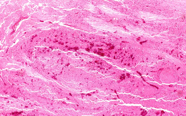 3B4 Hypotensive Brainstem Necrosis (Case 3) H&E N7A 4X