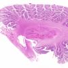 3C1 Hypotensive Brainstem Necrosis (Case 3) H&E N9 WM