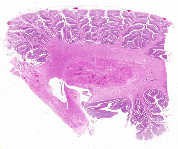 3C1 Hypotensive Brainstem Necrosis (Case 3) H&E N9 WM