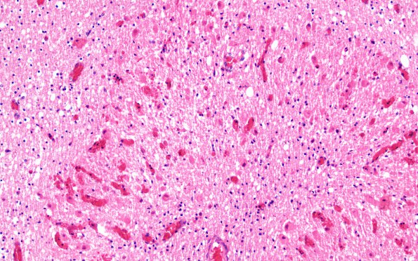 3C2 Hypotensive Brainstem Necrosis (Case 3) H&E N9 20X