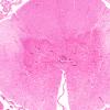 3D2 Hypotensive Brainstem Necrosis (Case 3) H&E N10 2X