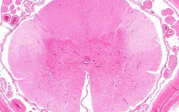 3D2 Hypotensive Brainstem Necrosis (Case 3) H&E N10 2X