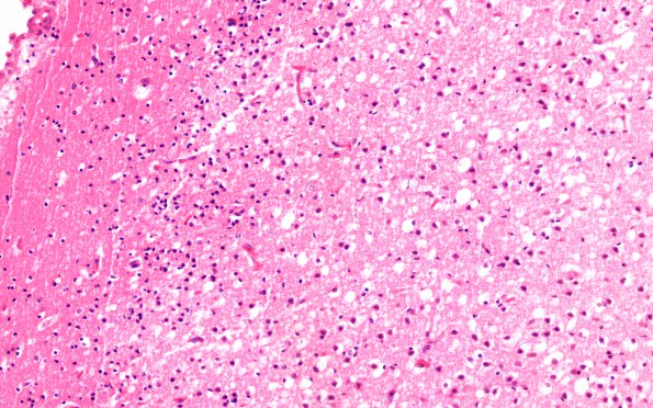 3E2 Hypotensive Brainstem Necrosis (Case 3) H&E N1 20X