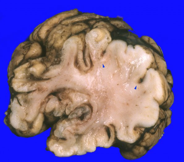 4A1 Hypotensive brain stem necrosis (Case 4) 2 copy