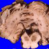 4A2 Hypotensive brain stem necrosis (Case 4) 1