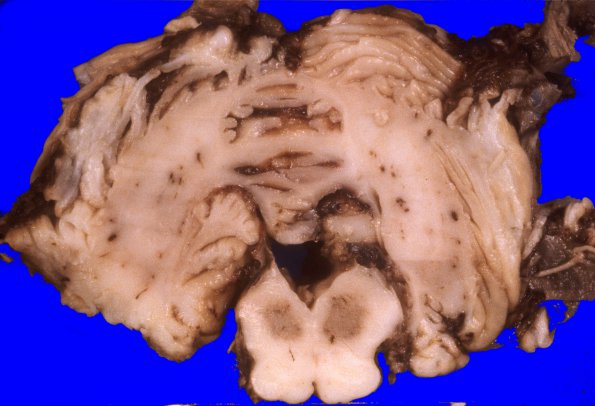 4A2 Hypotensive brain stem necrosis (Case 4) 1