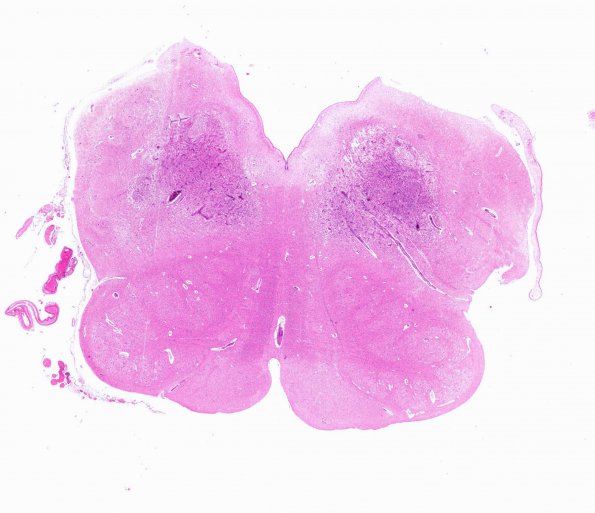 4B1 HOT brain stem necrosis (Case 4) H&E N6 WM