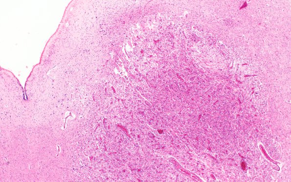 4B2 HOT brain stem necrosis (Case 4) H&E N6 4X