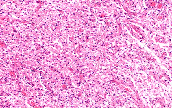 4B3 HOT brain stem necrosis (Case 4) H&E N6 20X