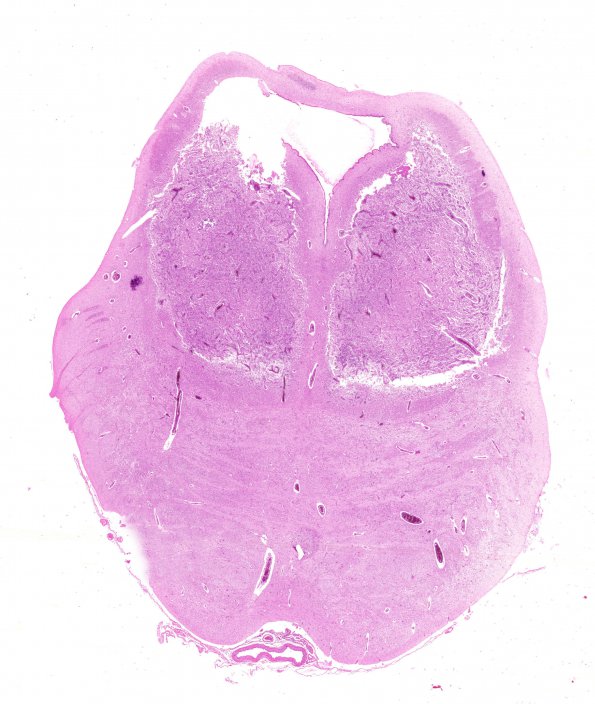 4C1 HOT brain stem necrosis (Case 4) H&E N5 WM