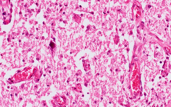 4C3 HOT brain stem necrosis (Case 4) H&E N5 40X