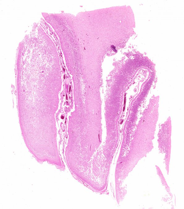 4E1 HOT brain stem necrosis (Case 4) H&E N1B