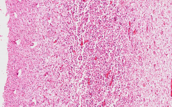 4E2 HOT brain stem necrosis (Case 4) H&E N1B 10X