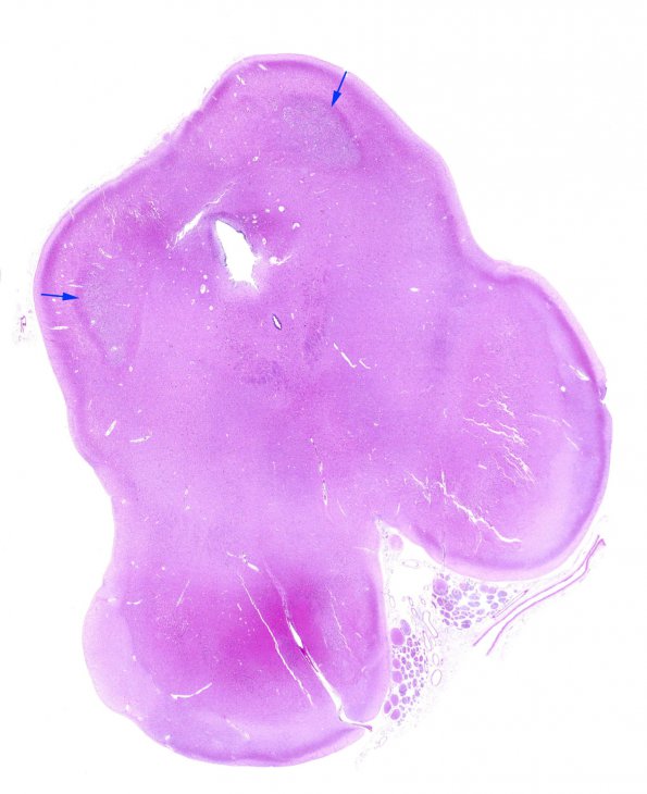 5A1 Hypotensive brainstem necrosis (Case 5) H&E WM copy