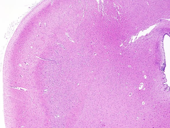 5A2 Hypotensive brainstem necrosis (Case 5) H&E 1 (2)