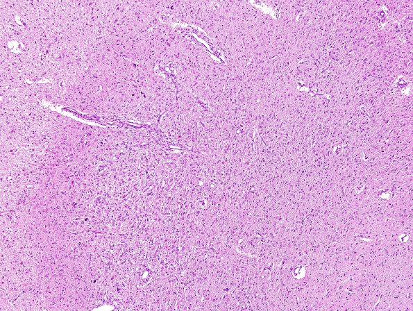 5A3 Hypotensive brainstem necrosis (Case 5) H&E 2 (2)