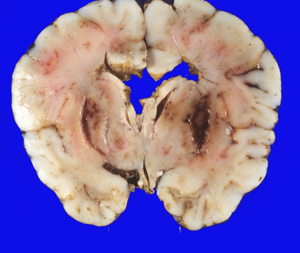 6A1 Hypoxia ischemia (Case 6) 3