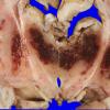 6A3 Hypoxia ischemia (Case 6) 1