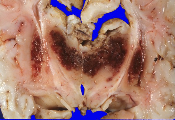 6A3 Hypoxia ischemia (Case 6) 1