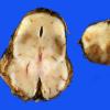 6A4 Hypoxia ischemia (Case 6) 3