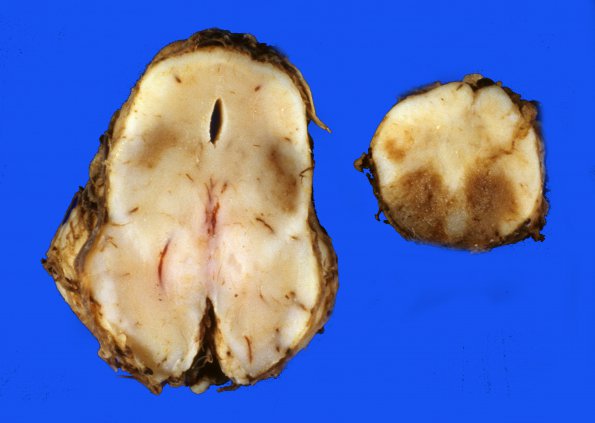 6A4 Hypoxia ischemia (Case 6) 3