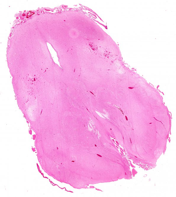 6B1 N Hypoxia ischemia (Case 6) Slide F H&E WM