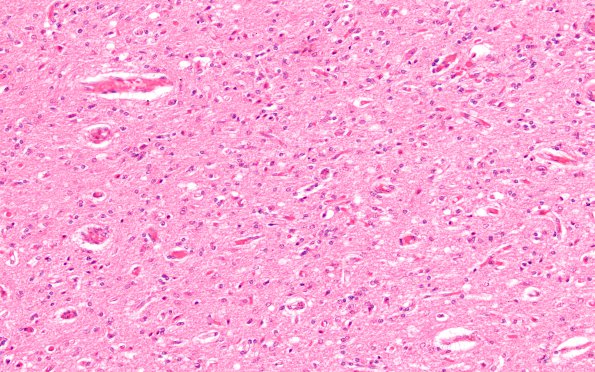 6B3 N Hypoxia ischemia (Case 6) Slide F H&E 20X