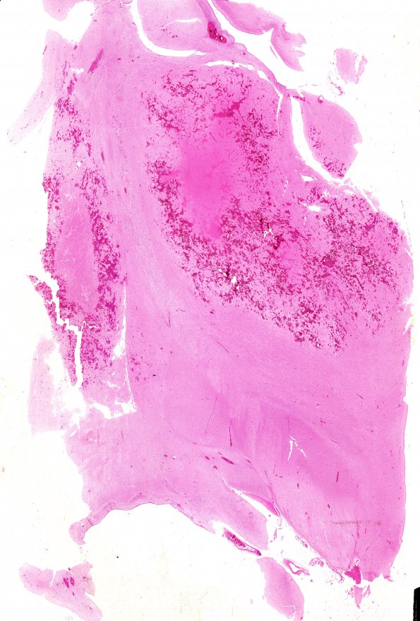 6C1 N Hypoxia ischemia (Case 6) Slide C H&E WM