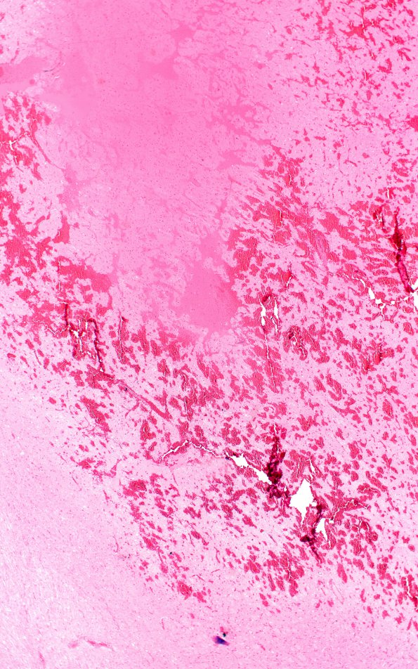 6C2 N Hypoxia ischemia (Case 6) Slide C H&E 2X