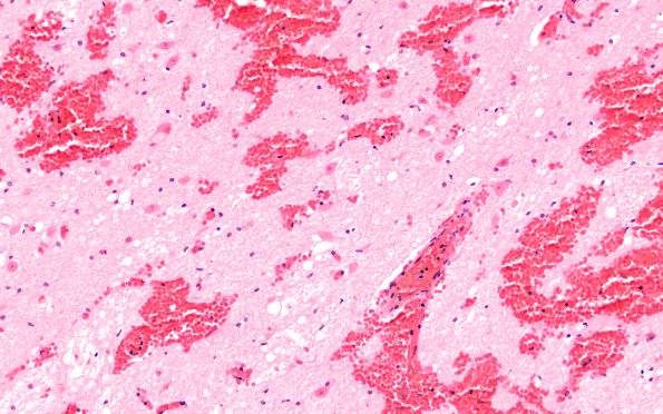 6C3 N Hypoxia ischemia (Case 6) Slide C H&E 20X