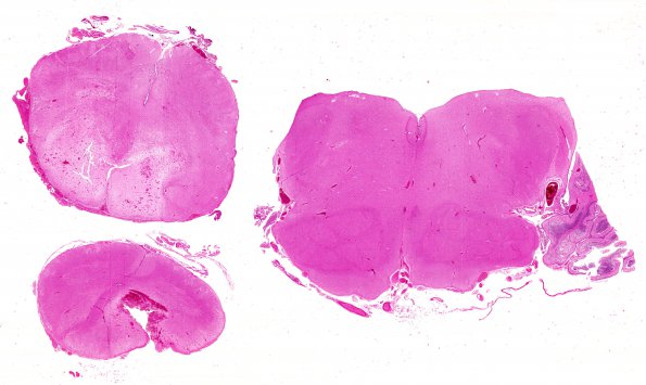 6D1 N Hypoxia ischemia (Case 6) Slide G H&E WM