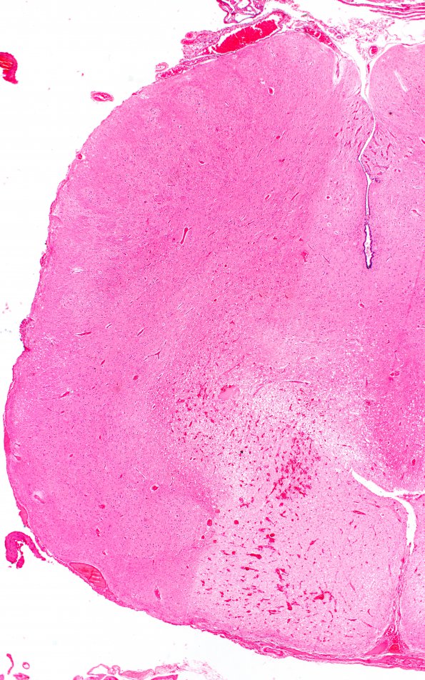 6D2 N Hypoxia ischemia (Case 6) Slide G H&E 2X