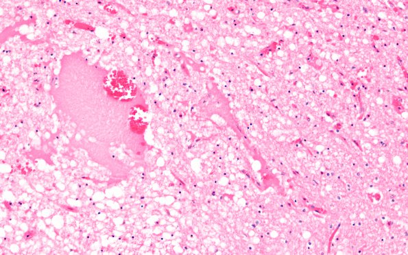 6D3 N Hypoxia ischemia (Case 6) Slide G H&E 20X