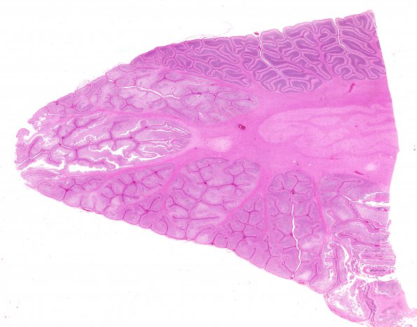 6E1 N Hypoxia ischemia (Case 6) Slide E H&E WM